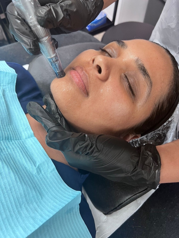 SKIN NEEDLING STARS